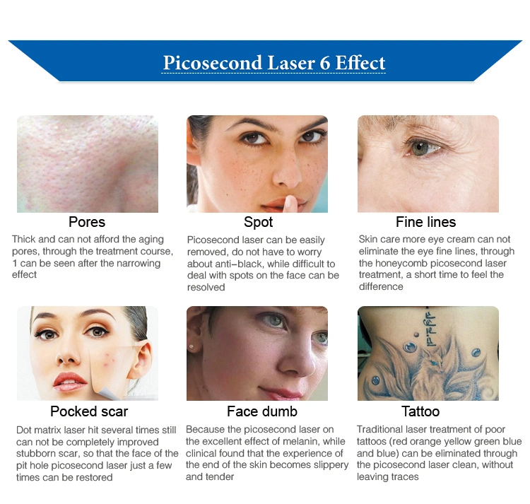 Guangzhou Factory Picosecond Pulsed Laser Tattoo Removal Specialist